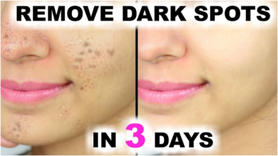 Remove Dark Spots Caused by Pimples