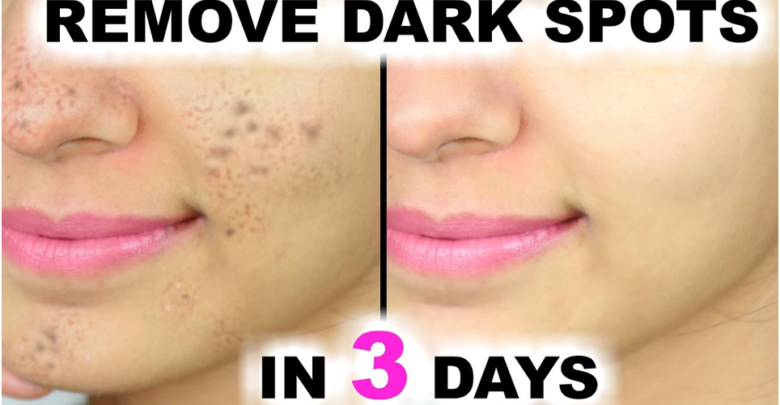Remove Dark Spots Caused by Pimples
