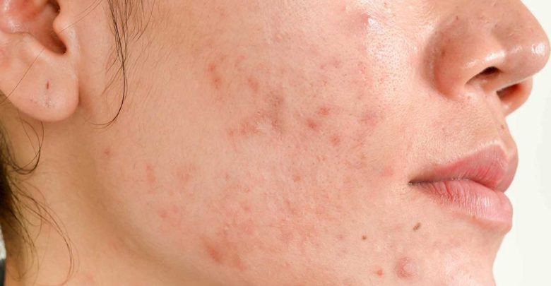Acne Scars What is New Out There